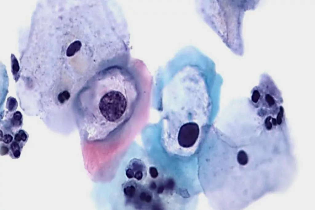 Imagen de citología cervicovaginal convencional que muestra discariosis de bajo grado con VPH