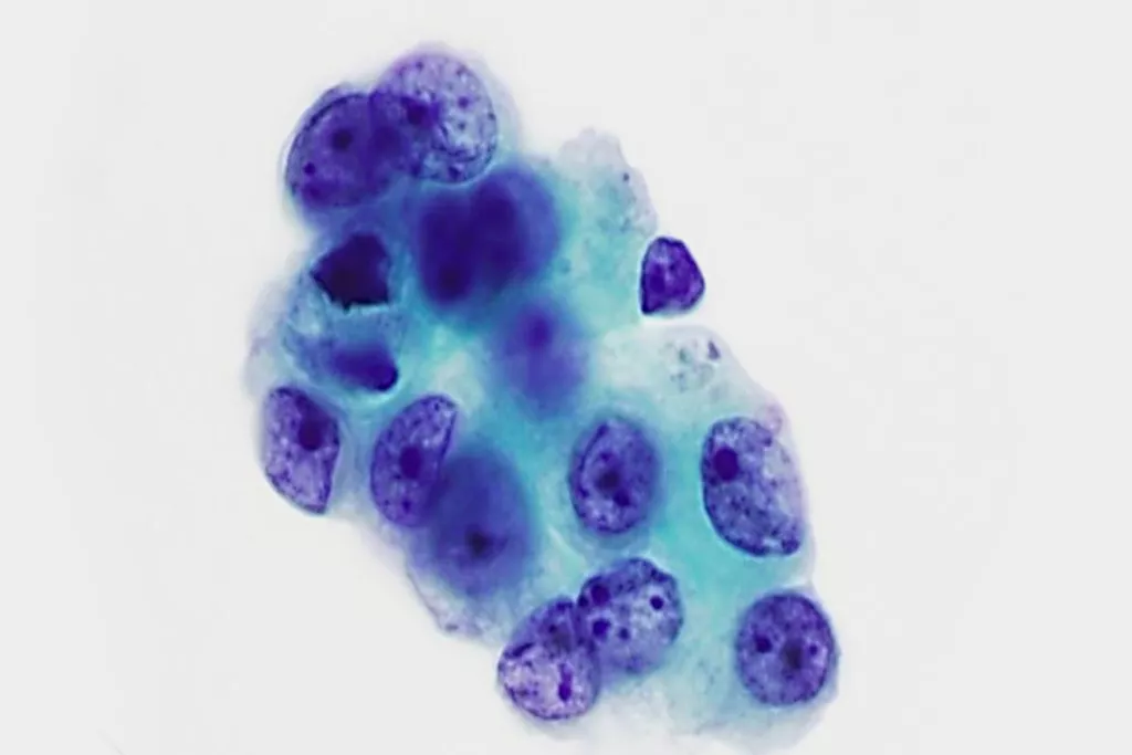 Adenocarcinoma, lavado bronquial, tinción de Papanicolaou