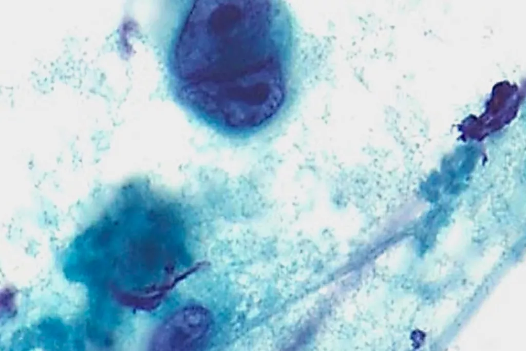 Linfoma de Hodgkin, PAAF en cuello, tinción de Papanicolaou