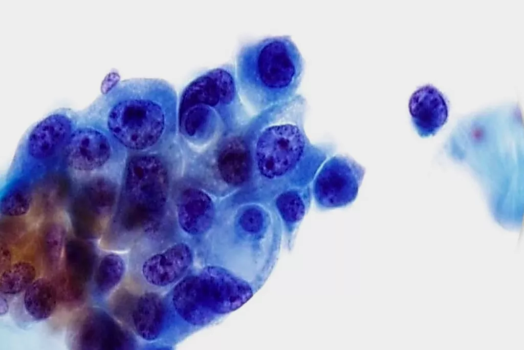 carcinoma de células transicionales, grado 3, orina, tinción de Papanicolaou