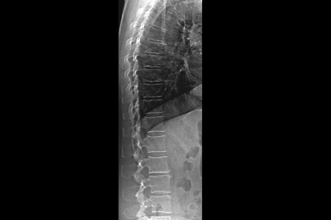 Radiografía de la columna vertebral