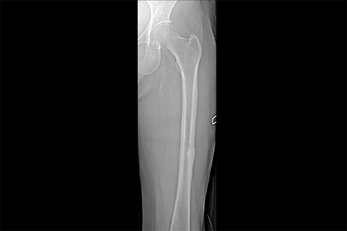 Radiografía de un hueso de la pierna