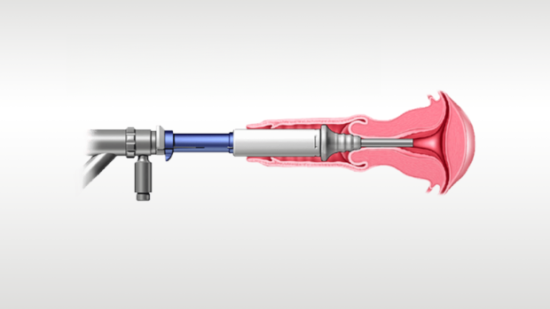 Ilustración de un instrumento médico en uso.